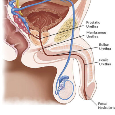 Urethroplasty-Surgery
